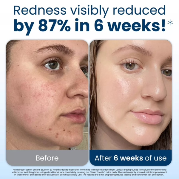 Clean Towel Redness Reduced 6 Weeks