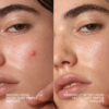 patch before and after Acne Pimple Patches, 36 Ct | #1 Hydrocolloid Acne Patches, Shrinking Zits & Whiteheads in 1 Use, Spot Treatment, Pimple Stickers for Face