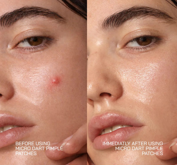 patch before and after Acne Pimple Patches, 36 Ct | #1 Hydrocolloid Acne Patches, Shrinking Zits & Whiteheads in 1 Use, Spot Treatment, Pimple Stickers for Face
